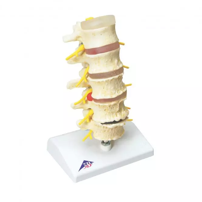 3B Scientific Modell Bandscheibenvorfall