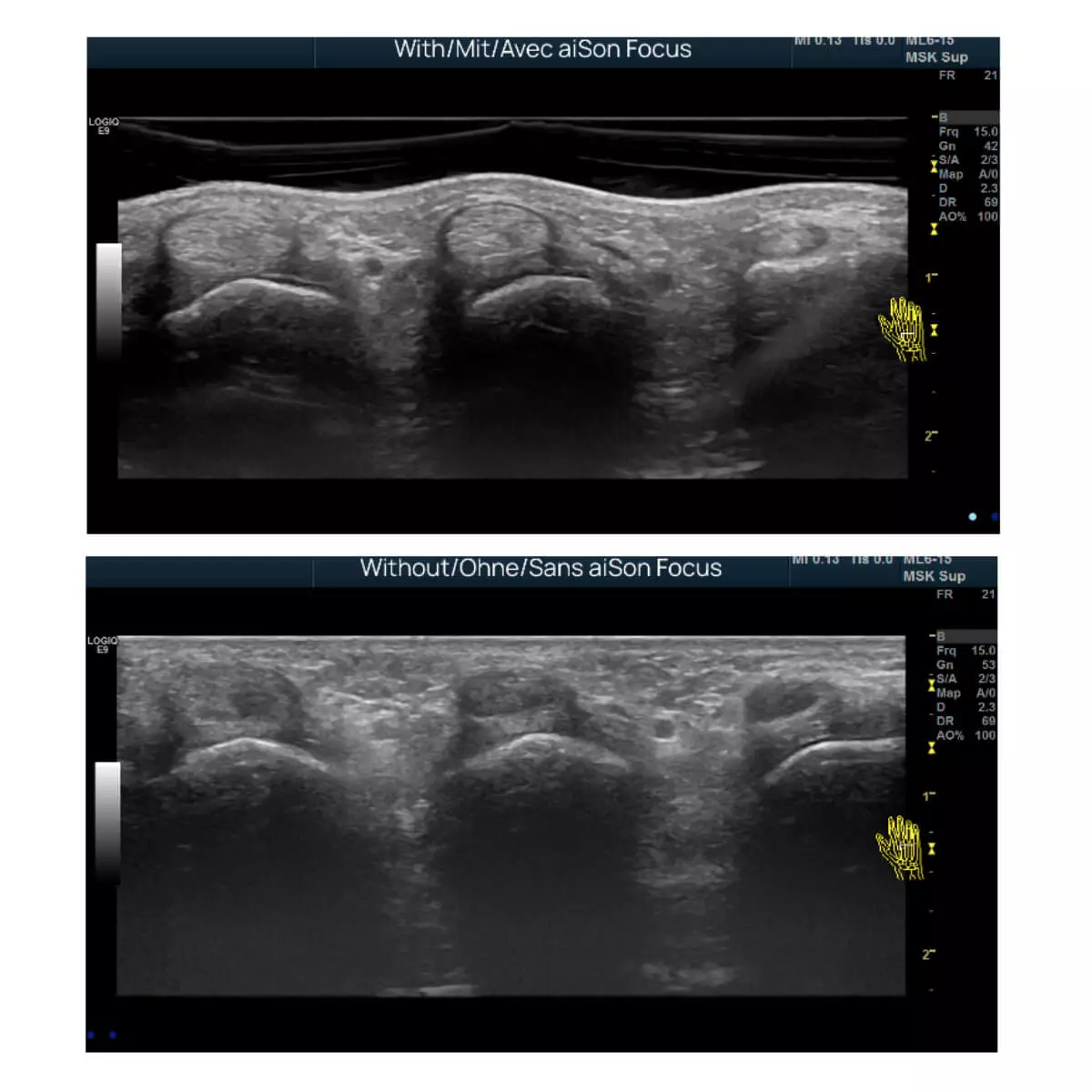 Aison Technologies aiSon FOCUS Gelpads für Ultraschallsonden