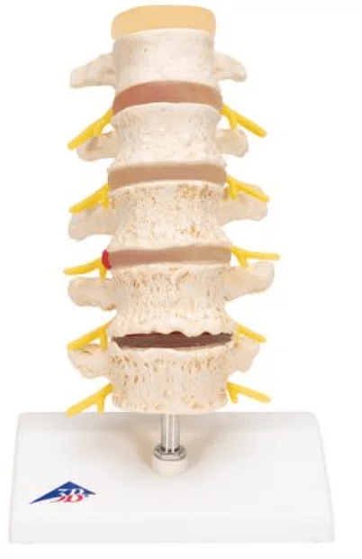 3B Scientific Modell Bandscheibenvorfall