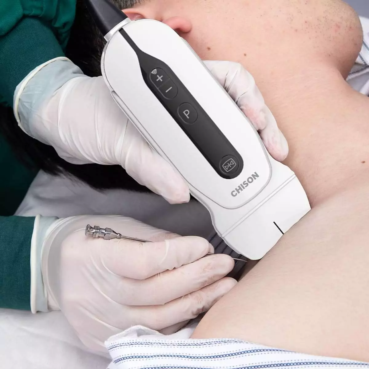 CHISON SonoEye G2 Handheld Ultraschallgerät