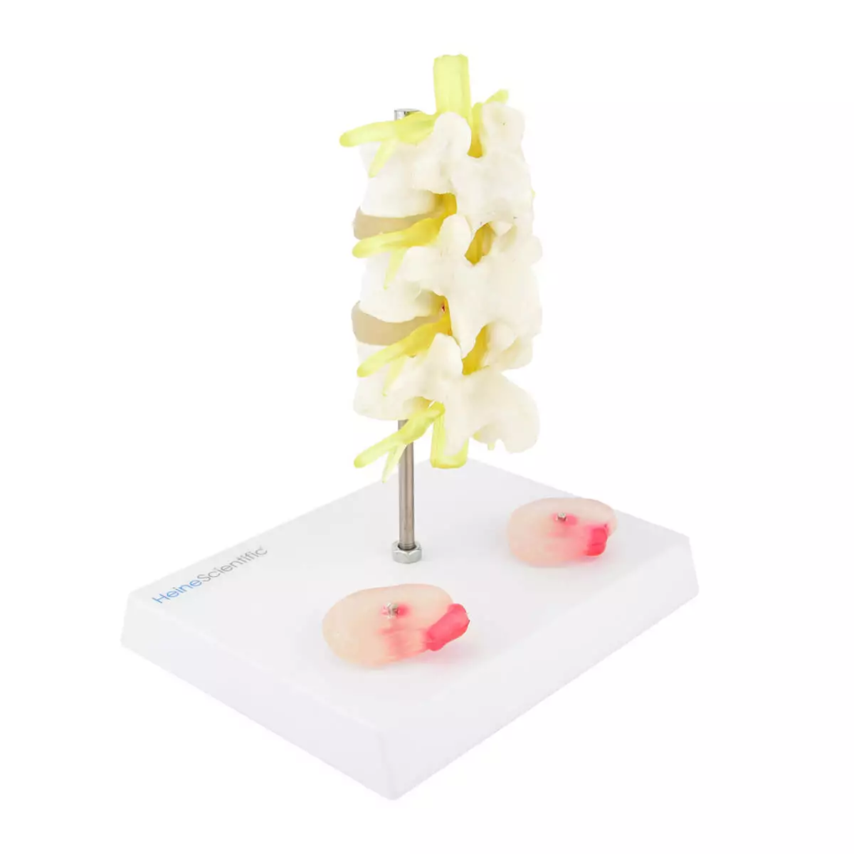 HeineScientific Modell Lendenwirbelsäule mit Bandscheibenvorfall HeineScientific Modell Lendenwirbelsäule mit Bandscheibenvorfall