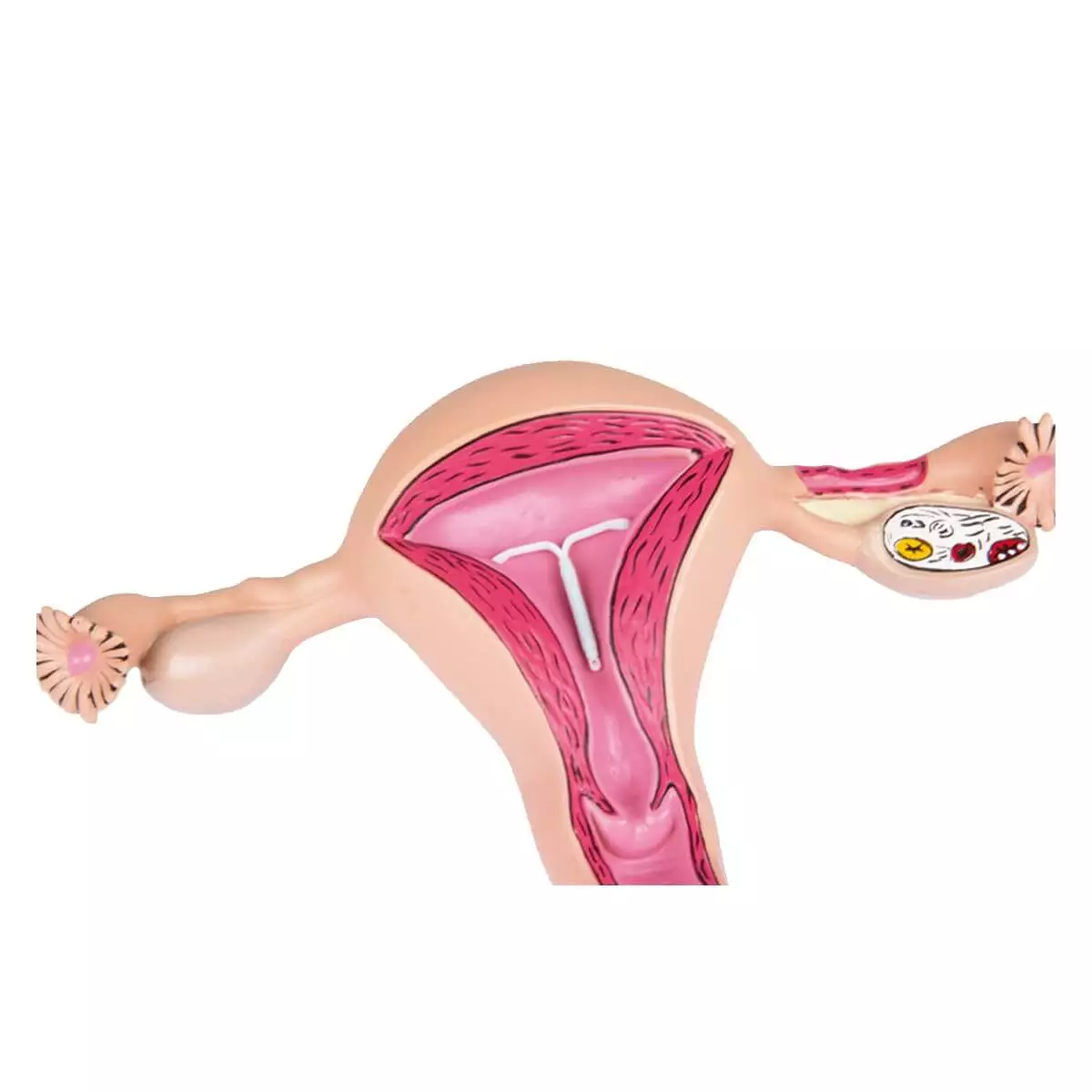 Erler-Zimmer Uterusmodell