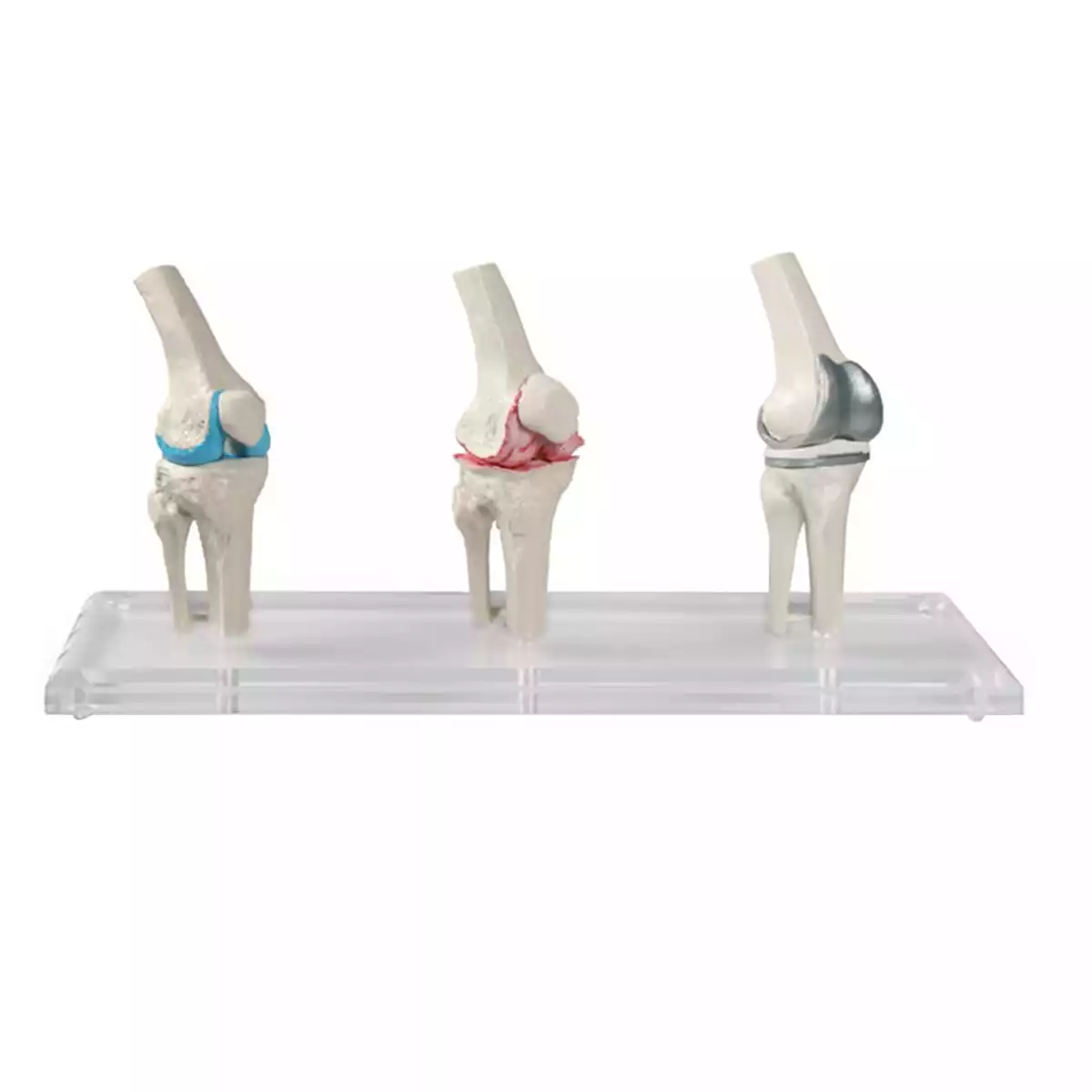 Erler-Zimmer Knie-Implantat-Modell