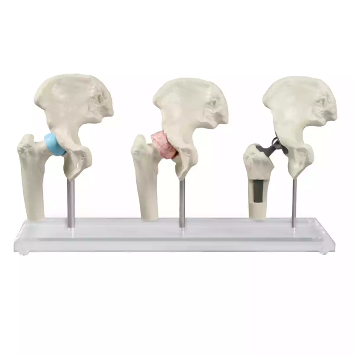 Erler-Zimmer Hüft-Implantat-Modell