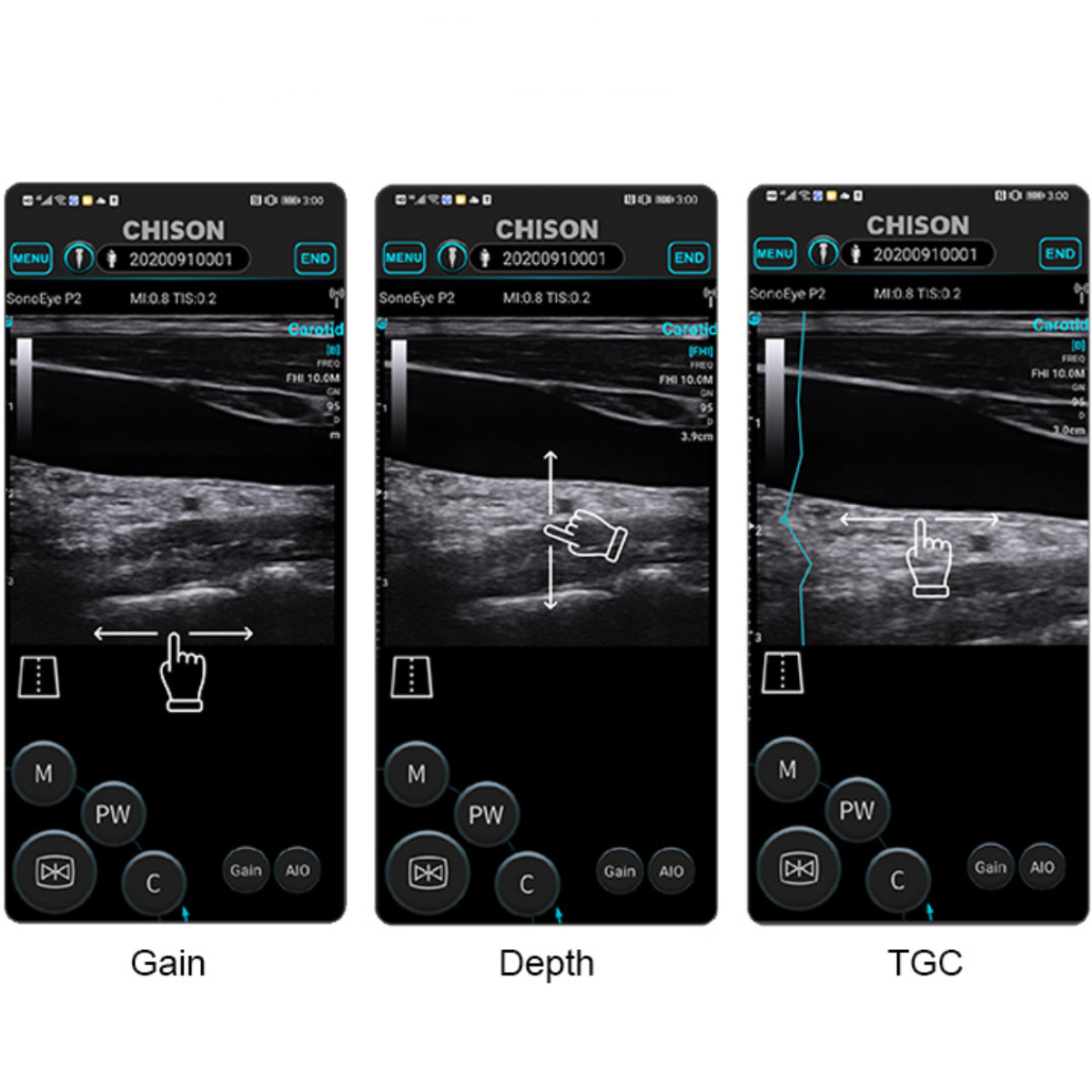 CHISON SonoEye mobiles Ultraschallsystem CHISON SonoEye mobiles Ultraschallsystem