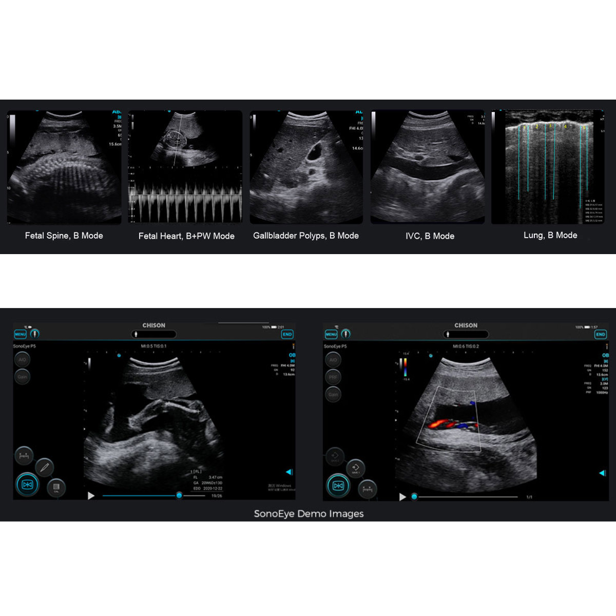 CHISON SonoEye mobiles Ultraschallsystem CHISON SonoEye mobiles Ultraschallsystem