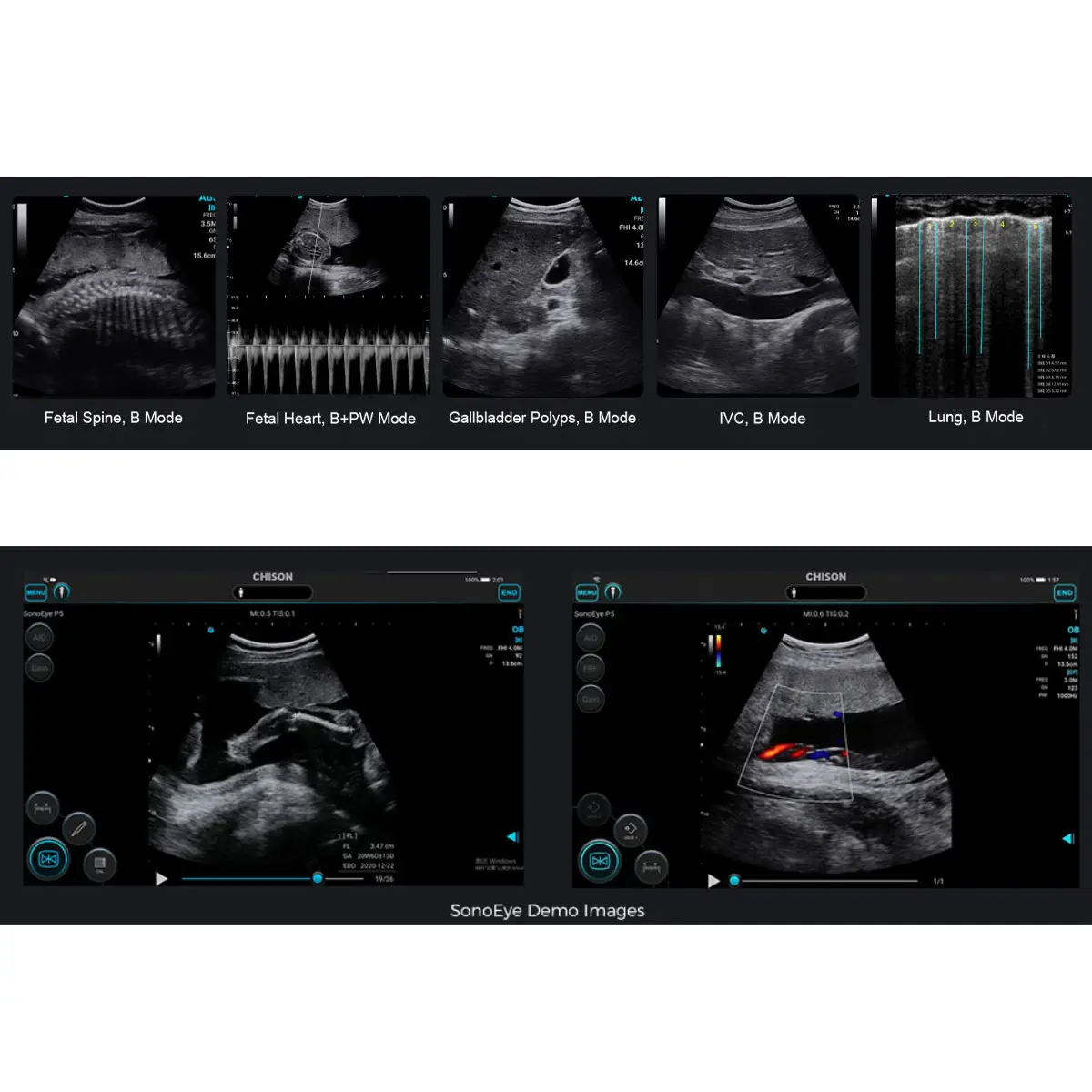 CHISON SonoEye mobiles Ultraschallsystem CHISON SonoEye mobiles Ultraschallsystem