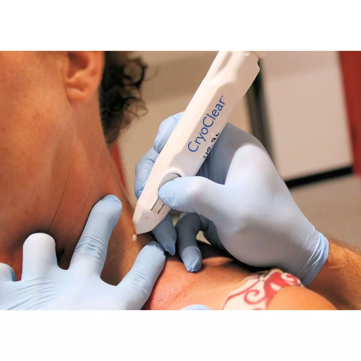 CryoConcepts CryoClear Kryotherapie